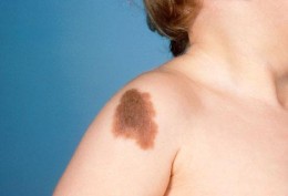 birth marks